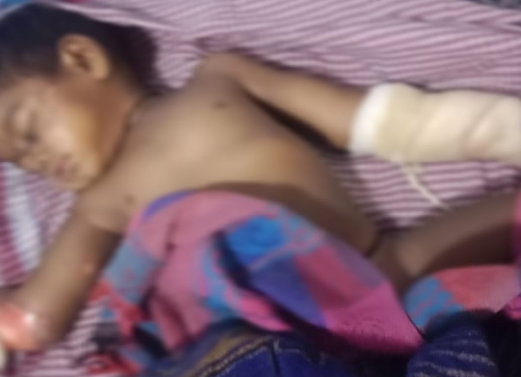 परिवार के साथ मेला देखने आई 2 साल की बच्ची गरम तेल की कढ़ाई में गिरी..बुरी तरह झुलसी बच्ची का इलाज जारी