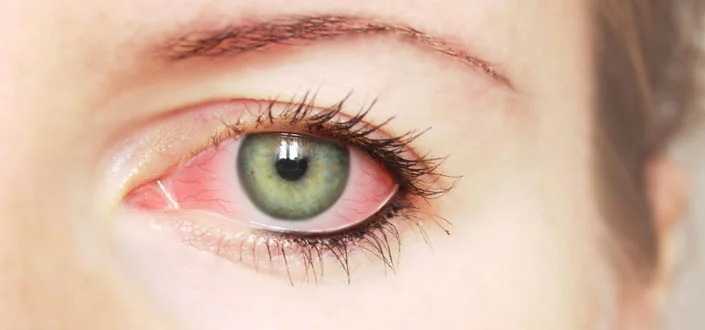 रहें सावधान : प्रदेशभर में सप्ताहभार में कंजेक्टिवाइटिस के 19 हजार मरीज सामने आए, स्वास्थ्य विभाग अलर्ट मोड पर