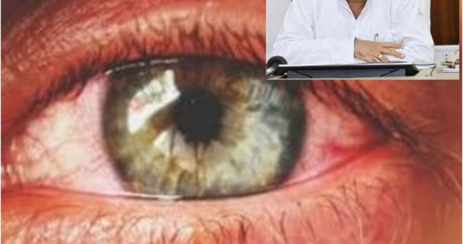 CG NEWS: बढ़ते कंजेक्टिवाइटिस के मामलें को लेकर सरकार अलर्ट मोड पर, मुख्यमंत्री बघेल ने आपात बैठक बुलाई