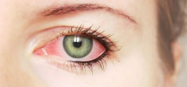 रहें सावधान : प्रदेशभर में सप्ताहभार में कंजेक्टिवाइटिस के 19 हजार मरीज सामने आए, स्वास्थ्य विभाग अलर्ट मोड पर