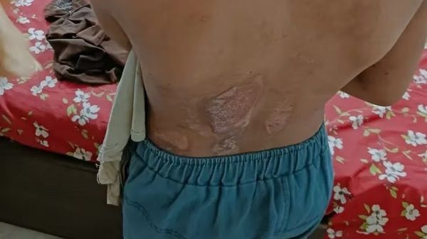 इंसानियत शर्मसार : 12 साल की बच्ची को गर्म तवे और चाकू से दागा, सिगरेट से जलाया