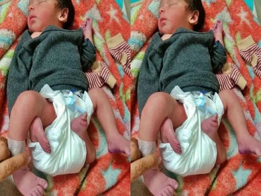 जिले में पैदा हुआ अनोखा बच्चा, बच्चे के है 4 हाथ और 4 पैर, डॉक्टर भी हैरान&hellip;